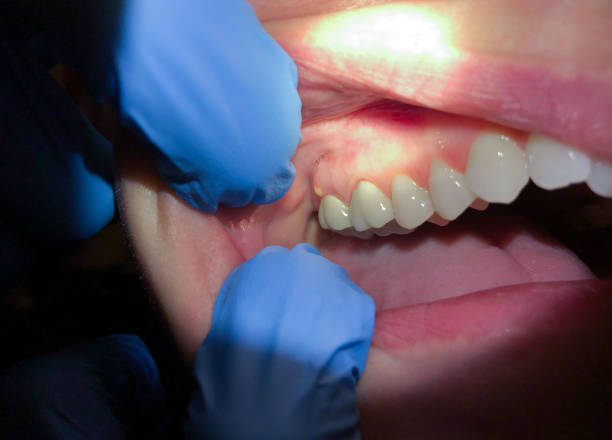 Best Emergency Tooth Extraction in Hoer, OK